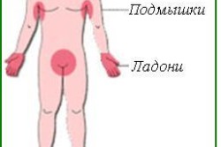 Локализация гипергидроза