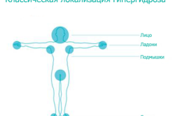 Основные причины и методы лечения повышенной потливости у женщин