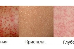 Виды потницы