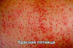 Виды потницы